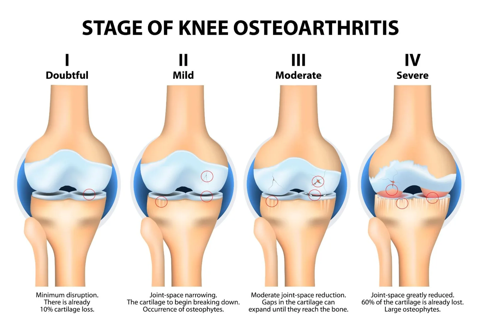 Total Knee Replacement Guide