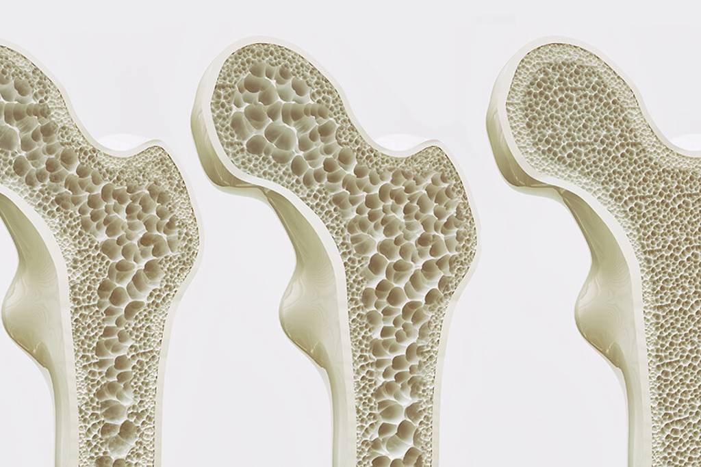 Understanding Osteoporosis: From Risk Factors to Management